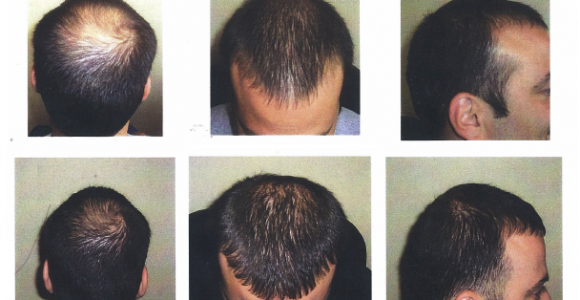 how to regrow hair in baldness area